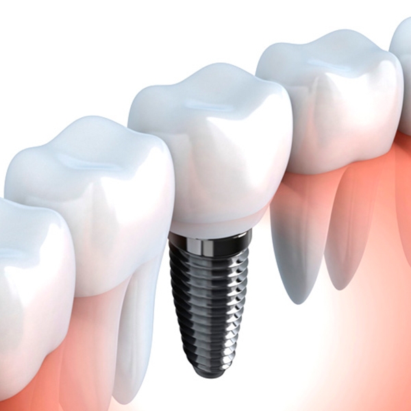 Implantes Dentales